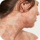 Dermatitis